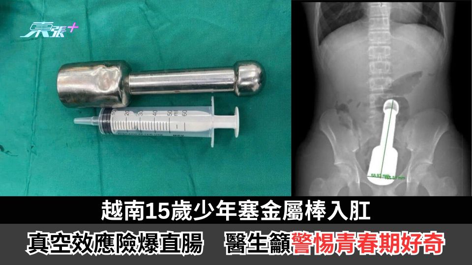 越南15歲少年塞金屬棒入肛　真空效應險爆直腸　醫生籲警惕青春期好奇