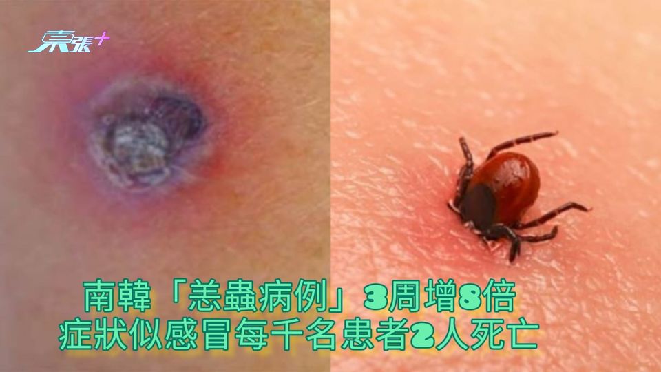 赴韓注意 | 南韓「恙蟲病例」3周增8倍 症狀似感冒每千名患者2人死亡