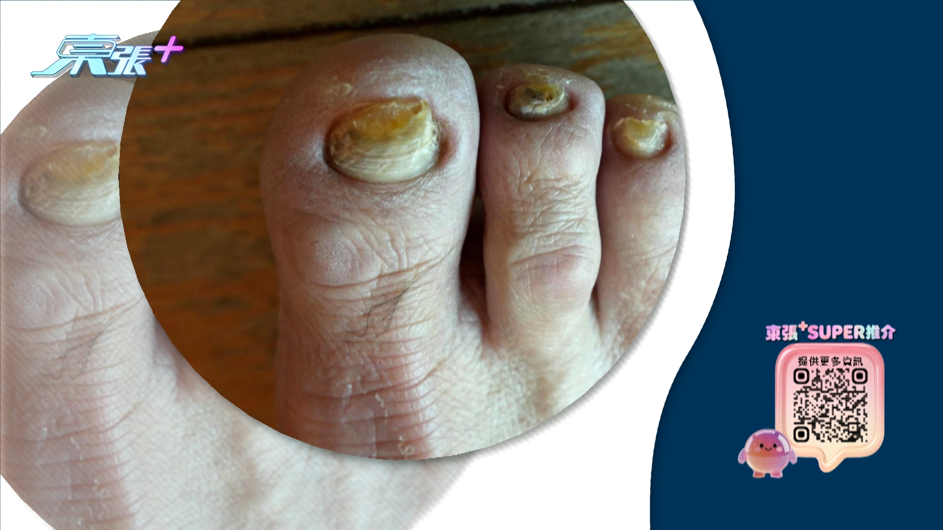 受訪者鄒先生指，曾經患有灰甲問題，他之前任保安工作，經常都要站立，又要巡邏，安全問題要穿密頭鞋，雙腳焗十多小時，不透氣又出汗，令到真菌滋生。