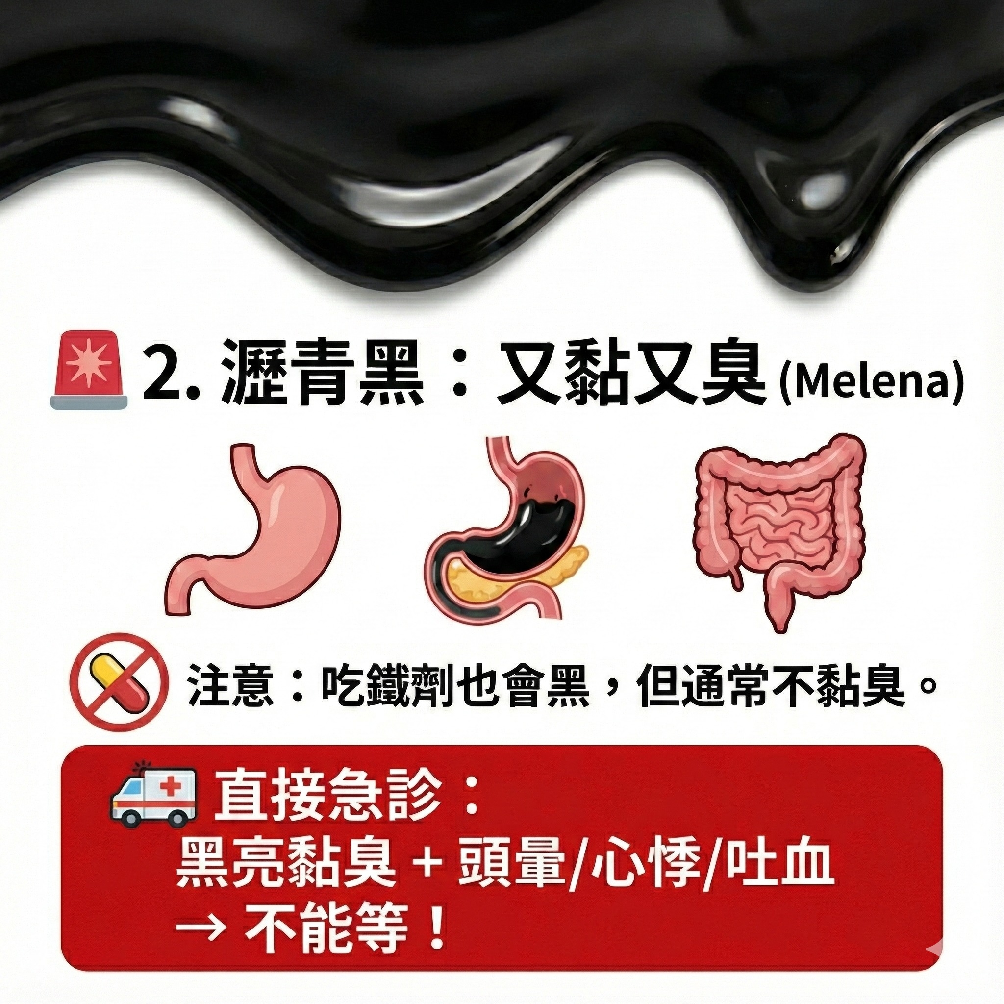 May be an image of text that says '*2. *2.匯青黑：又黏又臭(Melena 2. .潘青黑 又黏又臭 黑：又黏又臭( (Melena) 1১ ১২ 注意：吃鐵劑也會黑，但通常不黏 注意： 吃鏡劑也會黑 但通常不黏臭。 直接急診： 黑亮黏臭 黑亮黏臭+頭暈/心悸/吐血 + 頭量 心悸 吐血 → →不能等！'