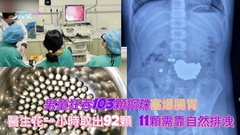 江蘇南通11歲男童狂吞103顆鋼珠塞爆腸胃 醫生花一小時取出92顆 11顆需靠自然排洩 
