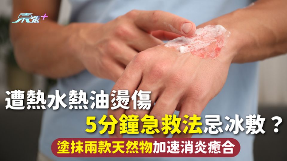 燙傷處理 | 遭熱水熱油燙傷 5分鐘急救法忌冰敷？塗抹兩款天然物加速消炎癒合