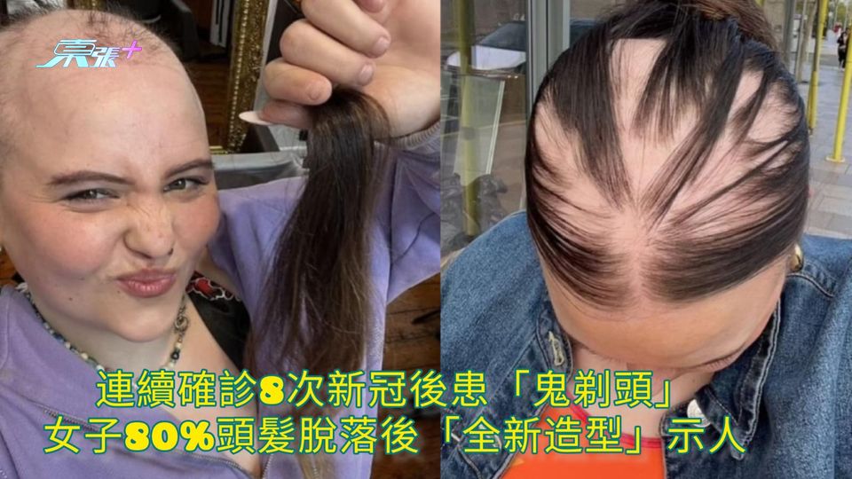 連續確診8次新冠後患「鬼剃頭」 女子80%頭髮脫落後「全新造型」示人