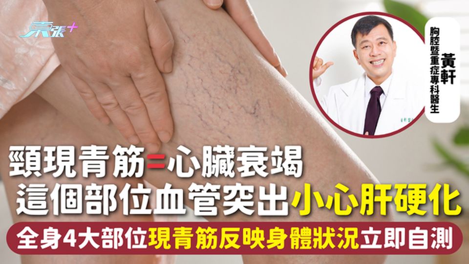 青筋 | 頸現青筋=心臟衰竭 這個部位血管突出小心肝硬化 全身4大部位現青筋反映身體狀況立即自測