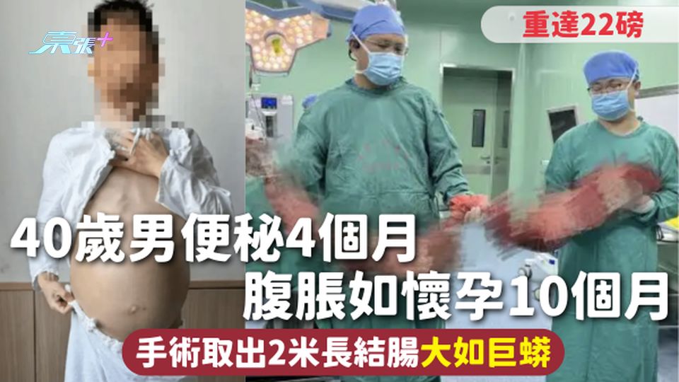 巨結腸症 | 40歲男便秘4個月 腹脹如懷孕10個月 手術取出2米長結腸大如巨蟒 重達22磅