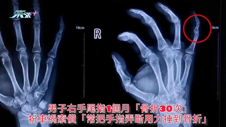 男子右手尾指1個月「骨折30次」 扮車禍索償「常把手指弄斷用力捶到骨折」