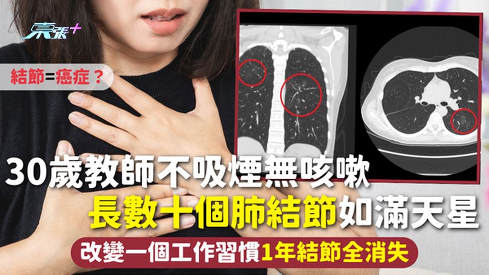30歲教師不吸煙無咳嗽 長數十個肺結節如滿天星 改變一個工作習慣1年結節全消失 拆解結節=癌症？