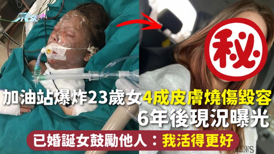 浴火重生 | 加油站爆炸23歲女4成皮膚燒傷毀容 6年後現況曝光 已婚誕女鼓勵他人：我活得更好