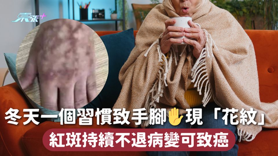冬天一個習慣致手腳✋現「花紋」 紅斑持續不退病變可致癌