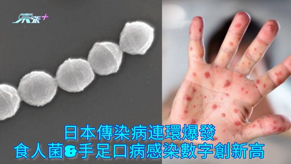 日本傳染病連環爆發 食人菌&手足口病感染數字創新高