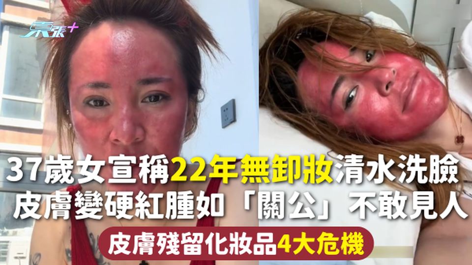 卸妝 | 37歲女宣稱22年無卸妝清水洗臉 皮膚變硬紅腫如「關公」不敢見人 皮膚殘留化妝品4大危機