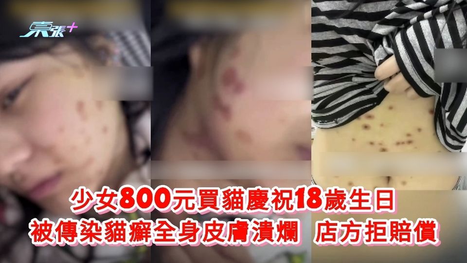 少女800元買貓慶祝18歲生日 被傳染貓癬全身皮膚潰爛 店方拒賠償