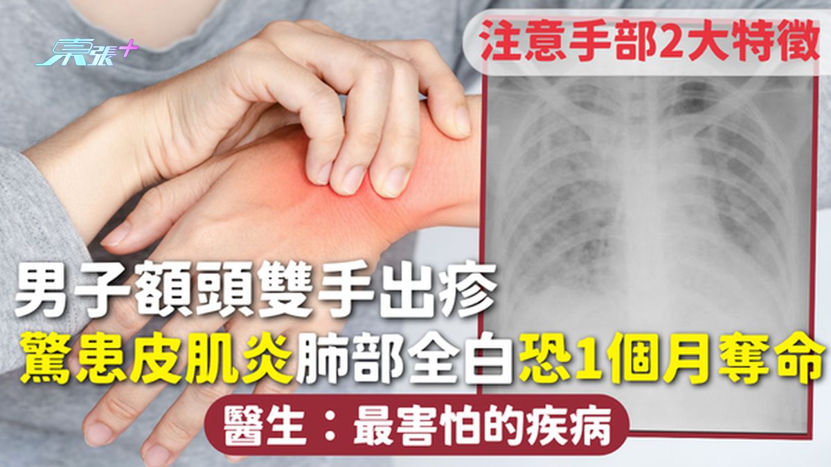 皮肌炎｜男子額頭雙手出疹 驚患皮肌炎肺部全白恐1個月奪命 醫生：最害怕的疾病 注意手部2大特徵