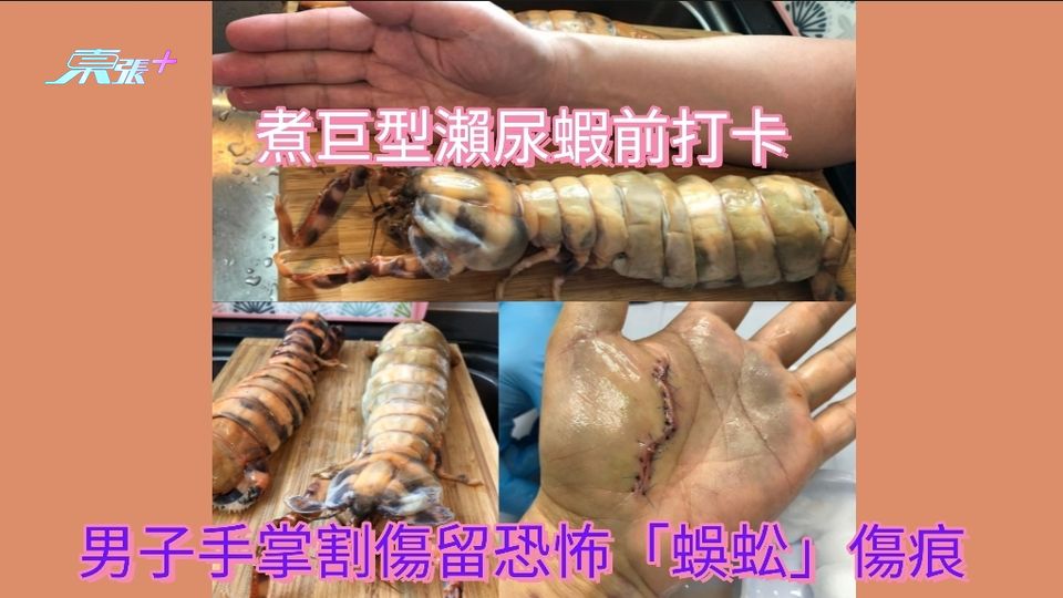 買巨型瀨尿蝦煮食前打卡 港男手掌割傷留恐怖「蜈蚣」傷痕