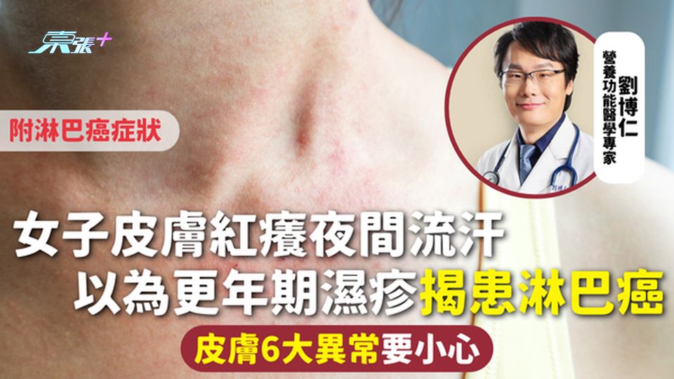 淋巴癌 | 女子皮膚紅癢夜間流汗 以為更年期濕疹揭患淋巴癌 皮膚6大異常要小心 附淋巴癌症狀