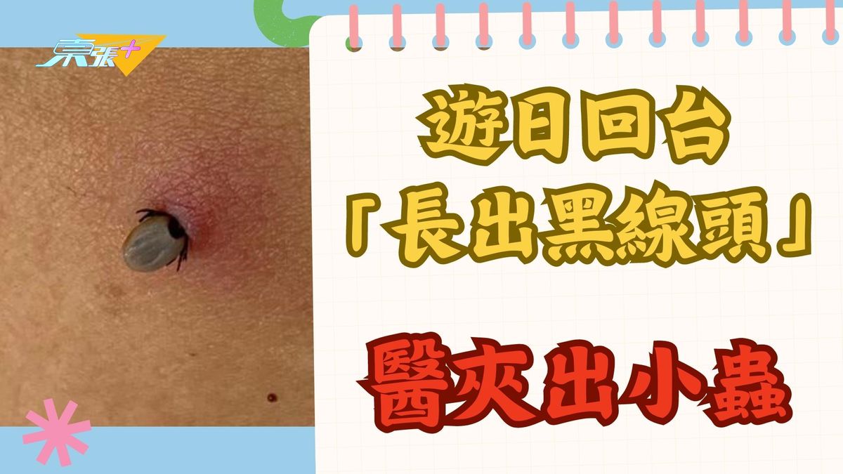 遊日回台「長出黑線頭」　醫夾出小蟲：恐引起萊姆病
