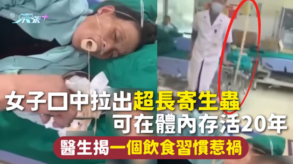 寄生蟲 | 女子口中拉出超長寄生蟲 可在體內存活20年 醫生揭一個飲食習慣惹禍