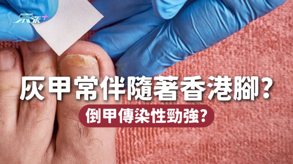 灰甲常陪香港腳🦶🏻灰甲會變成倒甲？傳染性勁強？