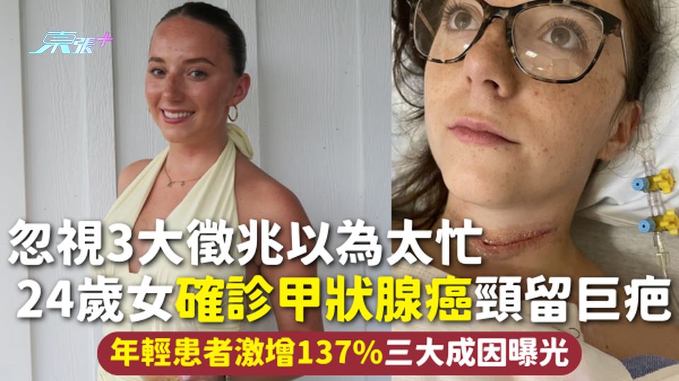 甲狀腺癌 | 忽視3大徵兆以為太忙 24歲女確診甲狀腺癌頸留巨疤 年輕患者激增137%三大成因曝光