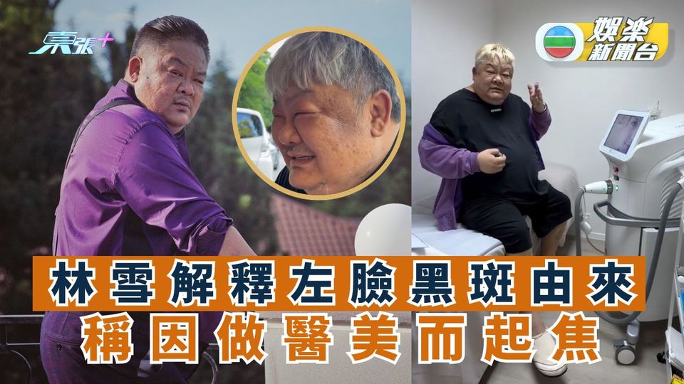 林雪解釋左臉黑斑由來 稱因做醫美而「起焦」