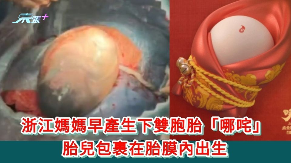 浙江媽媽早產生下雙胞胎「哪咤」 胎兒包裹在胎膜內出生