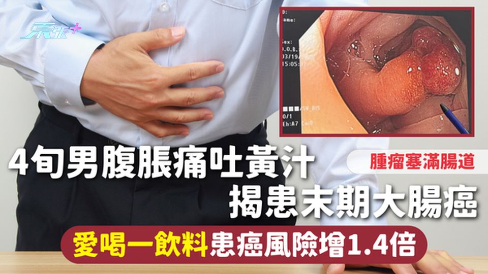 大腸癌 | 4旬男腹脹痛嘔黃汁 揭患末期大腸癌 腫瘤塞滿腸道 愛喝一飲料患癌風險增1.4倍
