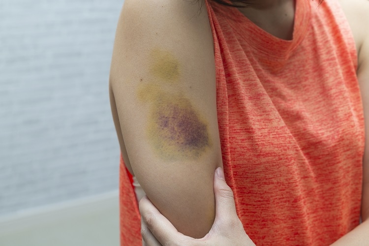 別再誤以為瘀青要揉才好得快! 冰敷.熱敷正確順序一次搞懂_生活保健_文章專區| 常春月刊--全宇宙最實用的保健知識