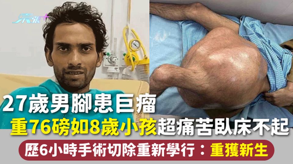 27歲男腳患巨瘤 重76磅如8歲小孩超痛苦臥床不起 歷6小時手術切除重新學行：重獲新生【有圖】