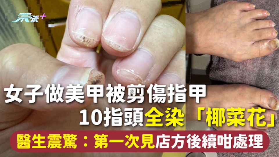 美甲注意 | 女子做美甲被剪傷指甲 10指頭全染「椰菜花」 醫生震驚：第一次見 店方後續咁處理