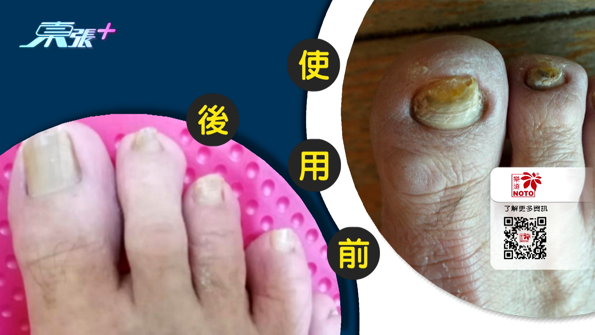 鄒先生表示，後來發現這款中藥灰甲水就一直用下去，「它不怕傷肝、腎，很適合我們三高人士，又不用銼甲，每日使用兩次，用了不久，又厚又黃的灰甲就慢慢褪走，新甲重生出來，而家我的腳終於見得人了！」