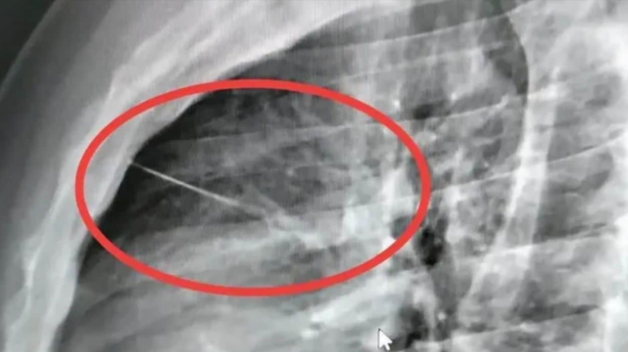 胸痛求醫竟X光揭胸腔「藏7厘米縫衣針」　險刺中心臟　泰男手術後情況危殆