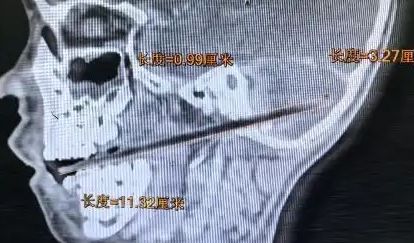 ▲竹籤刺進小朱顱內。（圖／翻攝自廣州日報）