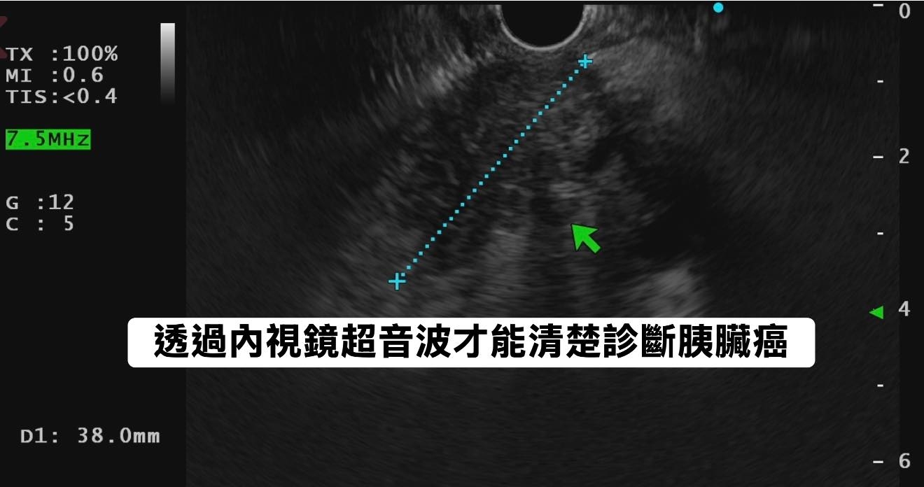 May be an image of xray and text that says 'Tχ ：１0０% MI :0.6 MI:0.6 6 TIS:<0.4 TIS: 4 .5MHZ G G:12 :12 c ：5 5 -2 D1:38.0m D1: 38 38.0mm 0mm 透過内視鏡超音波才能清楚診斷膜臟癌'
