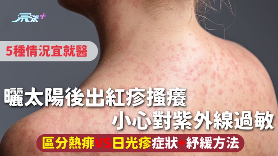 日光疹｜曬太陽後出紅疹搔癢 小心對紫外線過敏 區分熱痱VS日光疹 症狀+紓緩方法 5種情況宜就醫