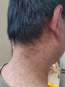 文中指基孔肯雅熱是由伊蚊傳播的急性傳染病，無特效藥可治。