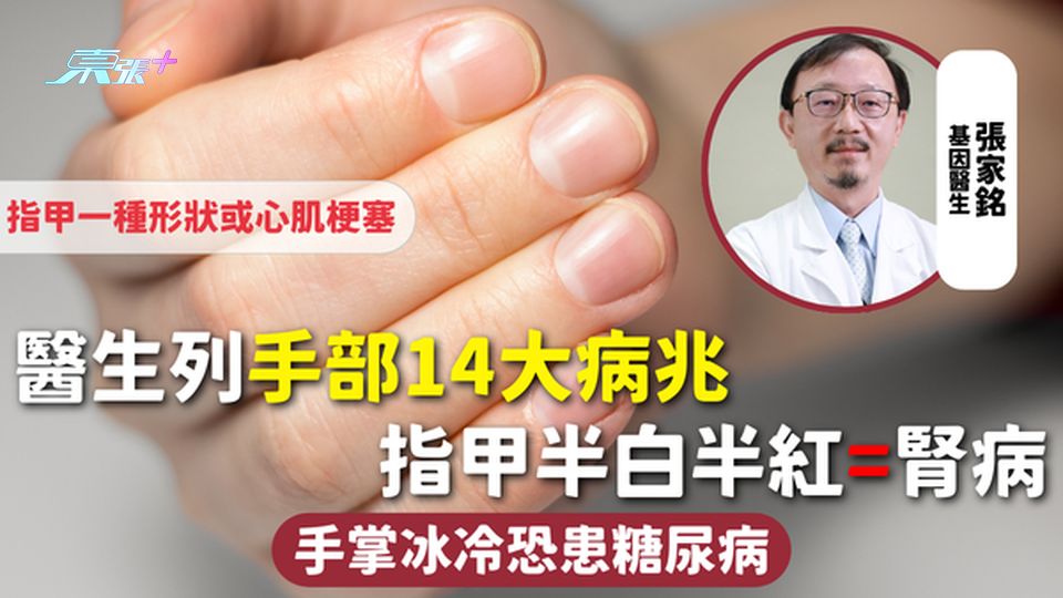 身體警號 | 醫生列手部14大病兆 指甲半白半紅=腎病 手掌冰冷恐患糖尿病 指甲一種形狀或心肌梗塞