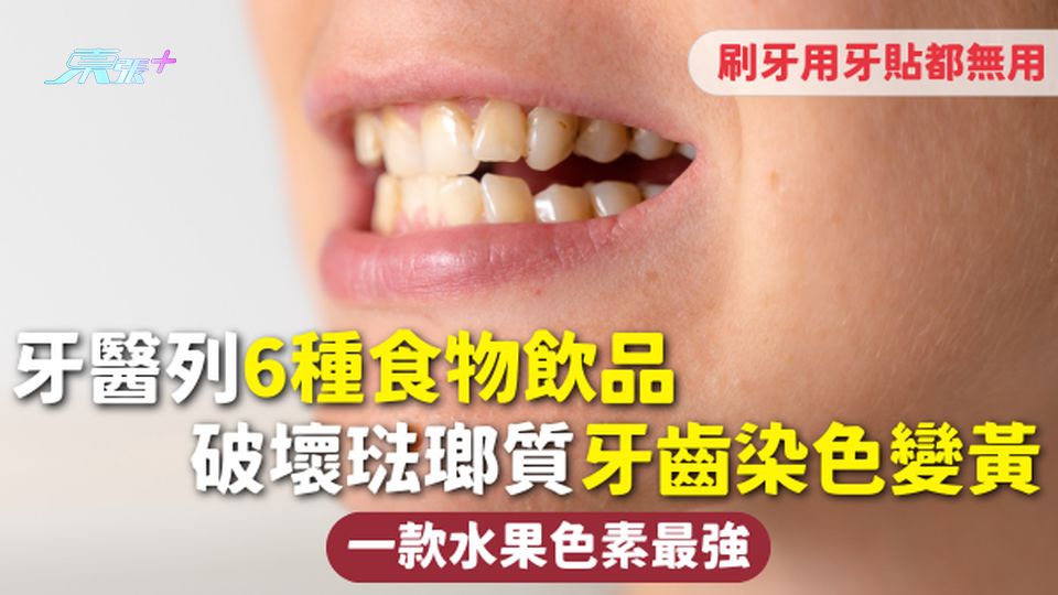 牙齒染色 | 牙醫列6種食物飲品 破壞琺瑯質牙齒染色變黃 刷牙用牙貼都無用 一款水果色素最強