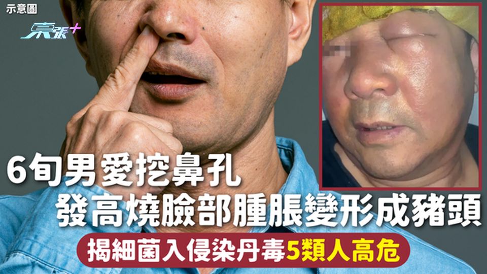 挖鼻孔 | 6旬男愛挖鼻孔 發高燒臉部腫脹變形成豬頭 揭細菌入侵染丹毒5類人高危