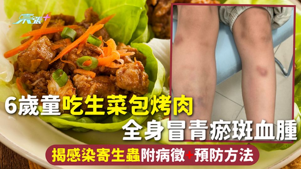寄生蟲 | 6歲童吃生菜包烤肉 全身冒青瘀斑血腫 揭感染寄生蟲 附病徵+預防方法