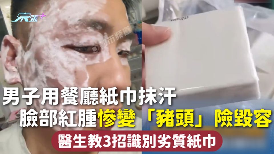 毒紙巾 | 男子用餐廳紙巾抹汗 臉部紅腫慘變「豬頭」險毀容 醫生教3招識別劣質紙巾