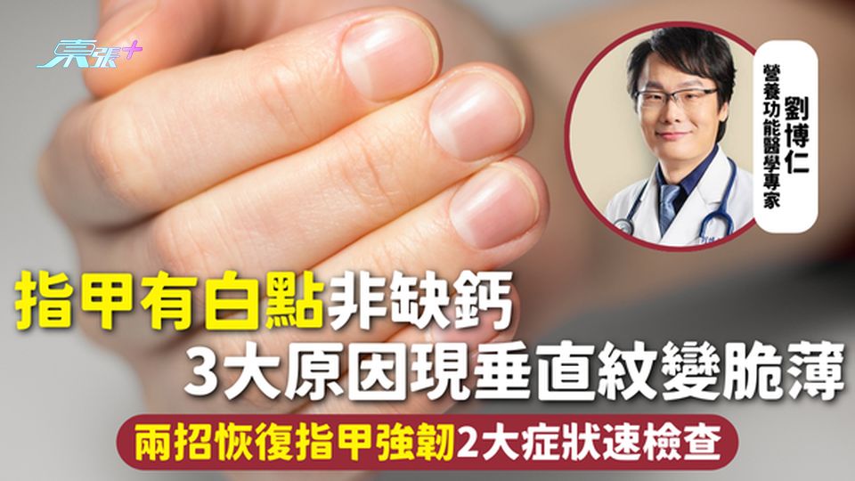 指甲白點 | 指甲有白點非缺鈣 3大原因現垂直紋變脆薄 兩招恢復指甲強韌2大症狀速檢查