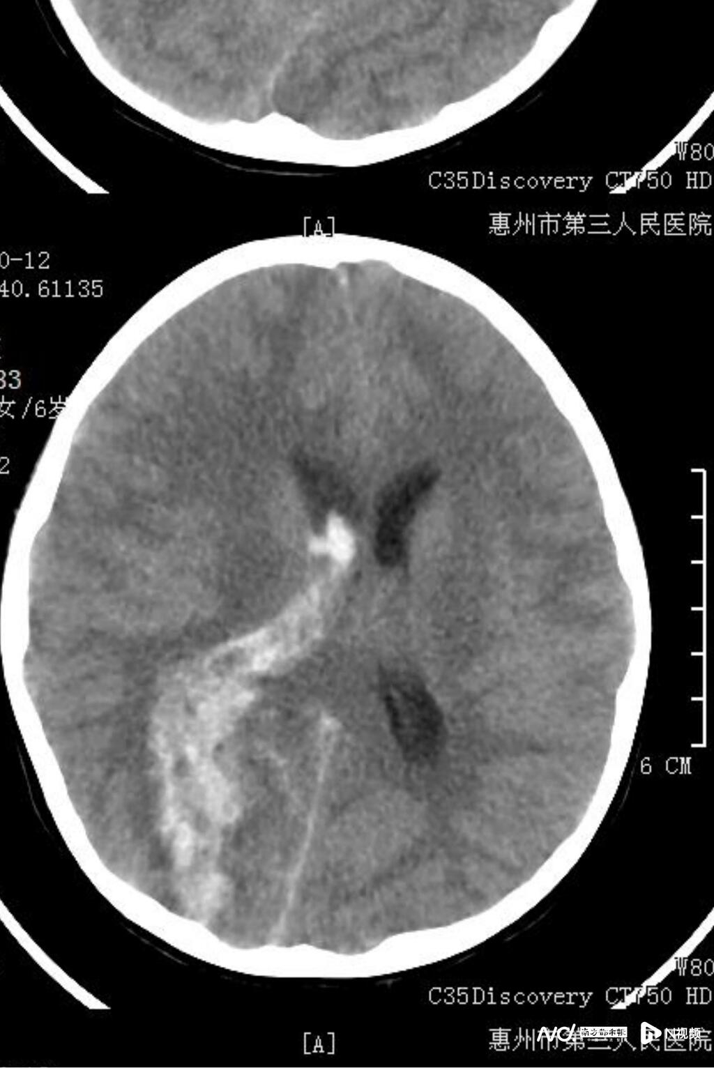 身上插滿管，眼睜大大，卻無法與旁人交流