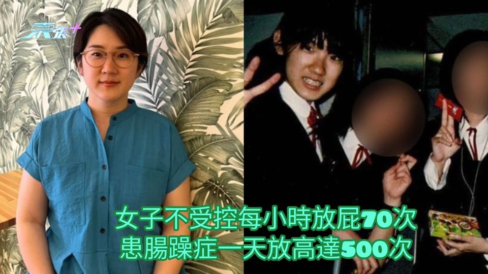女子不受控每小時放屁70次 患腸躁症一天放高達500次
