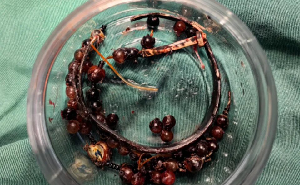 經約一小時手術處理，醫師順利將手鐲及串珠從增生組織中剝離，並進行清創與引流。（圖／翻攝自微博）