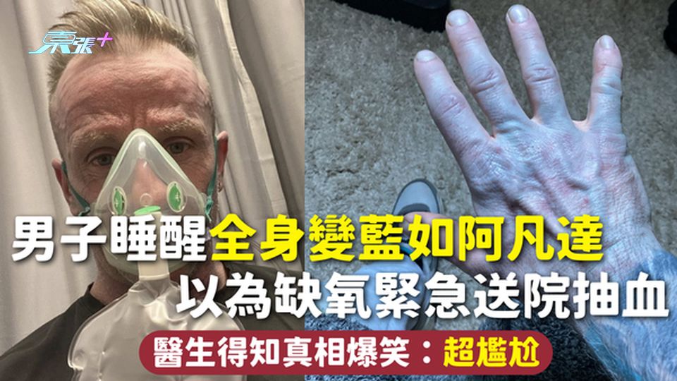 男子睡醒全身變藍如阿凡達 以為缺氧緊急送院抽血 醫生得知真相爆笑：超尷尬