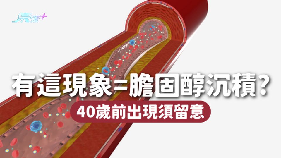 👀眼晴出現這種現象，是膽固醇沉積！？40歲前出現好大件事