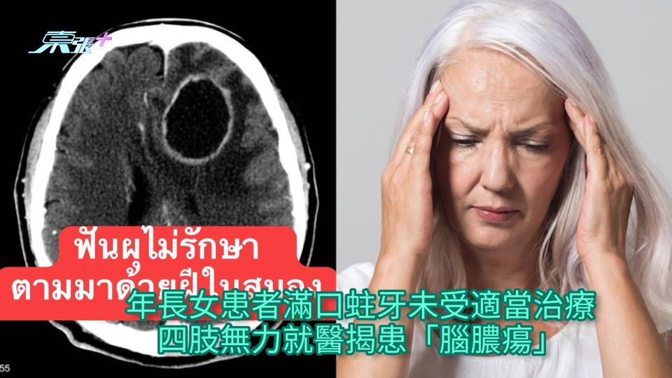 年長女患者滿口蛀牙未受適當治療 四肢無力就醫揭患「腦膿瘍」