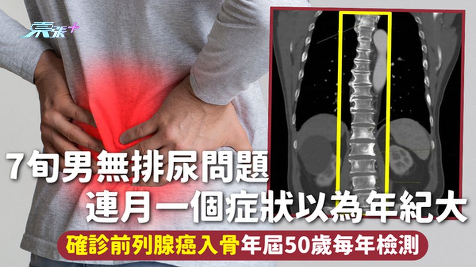 前列腺癌 | 7旬男無排尿問題 連月一個症狀以為年紀大 確診前列腺癌入骨 年屆50歲每年檢測