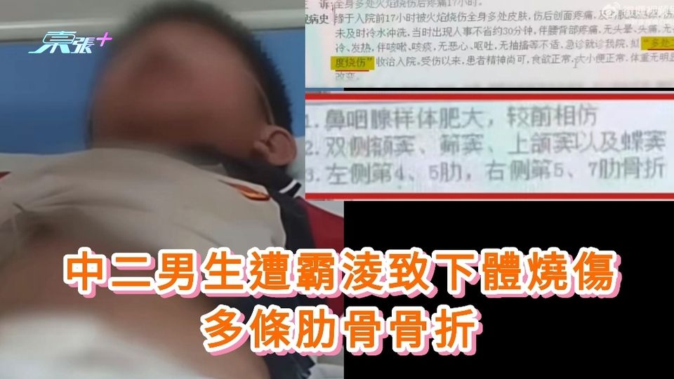 中二男生遭校園霸淩致下體燒傷 多條肋骨骨折
