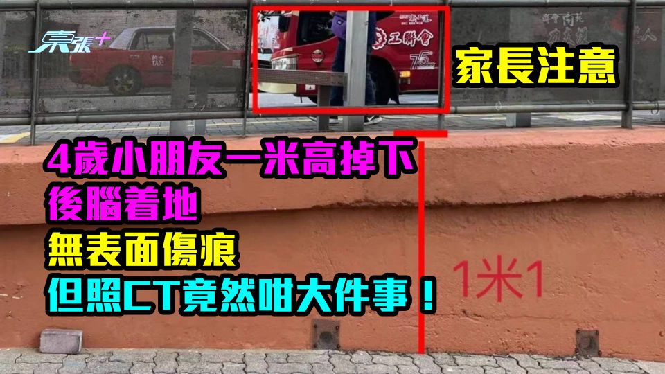 家長注意｜4歲小童一米高掉下後腦着地　無表面傷痕但照CT竟然咁大件事！